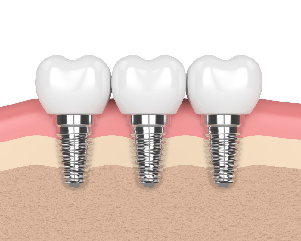 Three Dental Implants Illustration