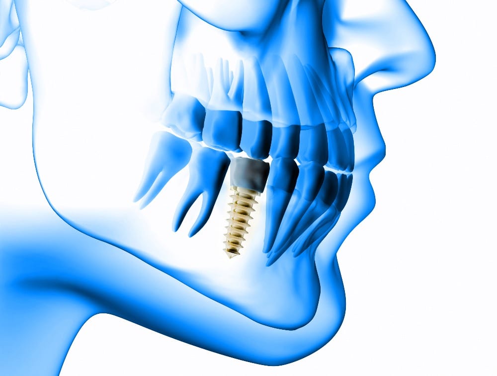 Dental Implant X Ray Illustration