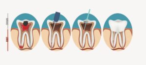 Root Canal Treatment