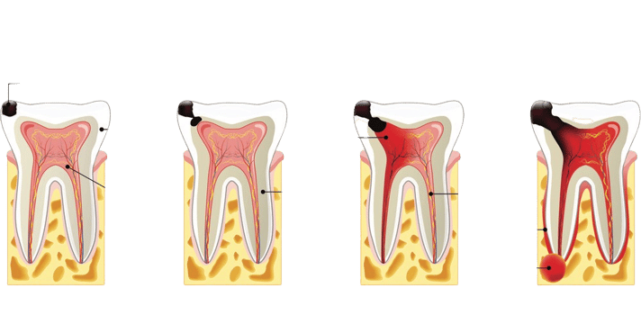 Stages of Caries Development