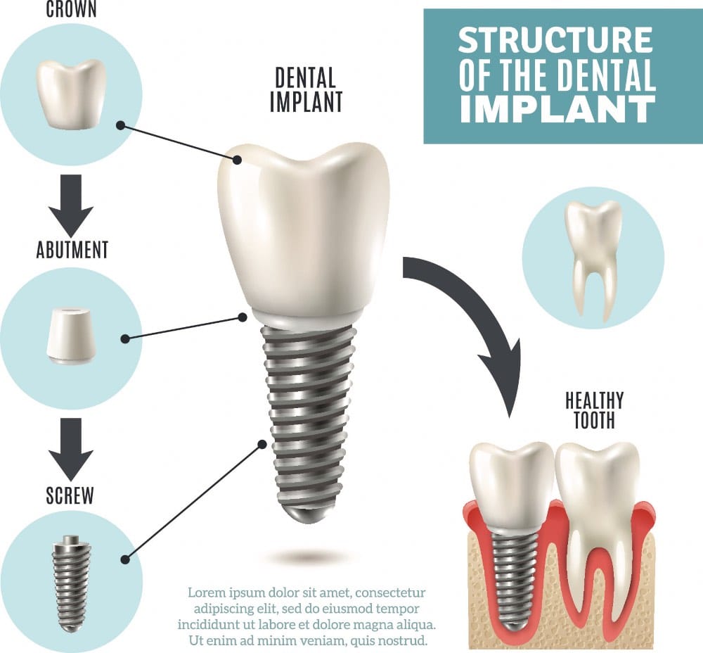 Structure of the Dental Implant