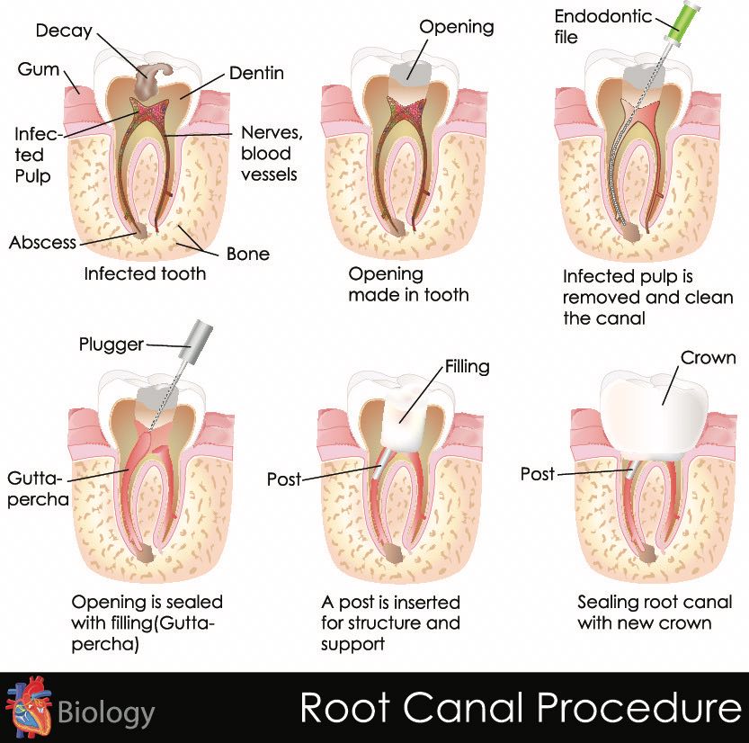 Root Canal Procedure